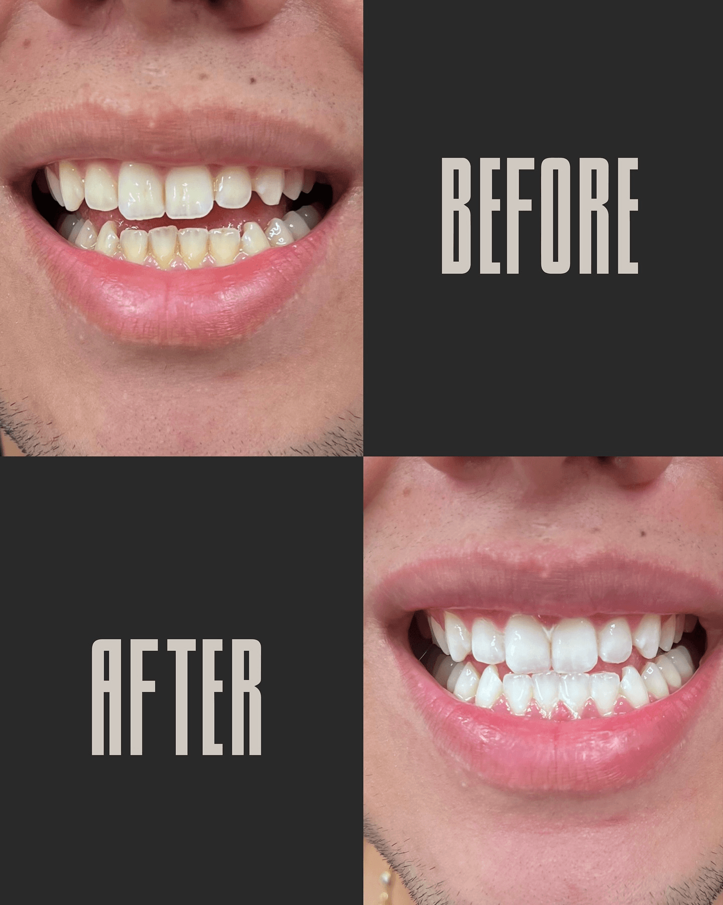 Teeth whitening before and after results